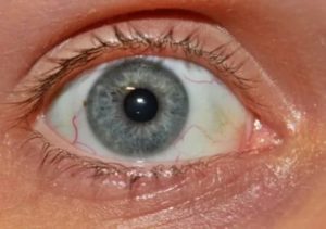Красные сосуды на белках глаз
