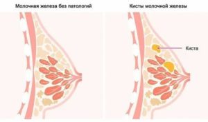 Грудь перед месячными
