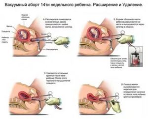 Медикаментозный аборт при внематочной беременности