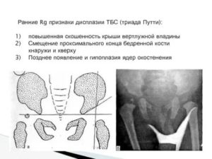 Гипоплазия ядер окостенения ТС