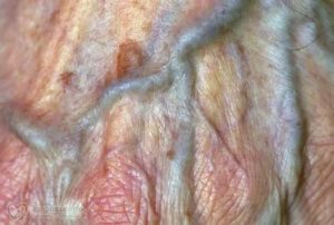 Трещинки на половых губах во время беременности