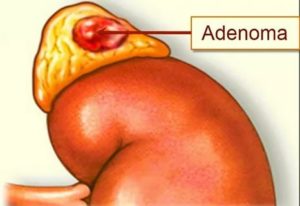 Аденома надпочечников
