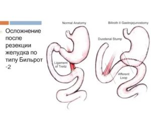 Температура после резекции желудка