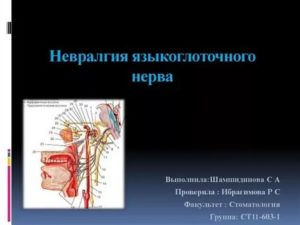 Невралгия языкоглоточного нерва?