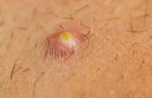 Болезненное образование на половой губе