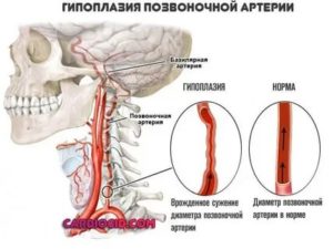 Снижен кровоток по левой па