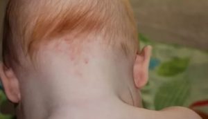 Красные точки на шее у ребенка