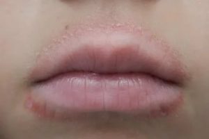 Шелушение и покраснение вокруг рта