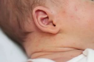 Сыпь за ушком у новорожденного