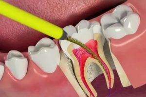 Зуб после перелечивания каналов болит, что делать?