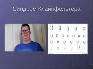 Синдром клайнфельтера