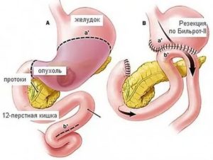 Операция 12 перстной кишки удалили часть кишечника