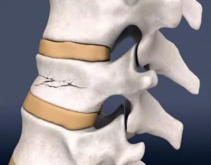 Компрессионный перелом L2 позвонка поясничного отдела позвоночника