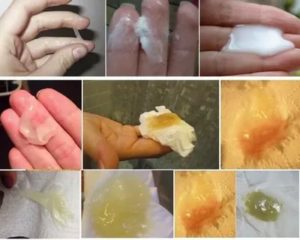 Могут ли быть после вагинальных свечей белые выделения?