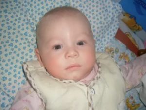Шишка на переносице у ребёнка в 4 месяца