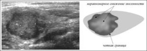 Гипоэхогенный узел с неровным контуром