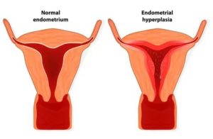 Гипоплазия эндометрия