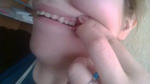 После удаления зуба торчит что-то острое из десны