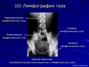 Отчего могут увеличиваться парааортальные лимфоузлы