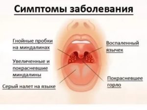 Пробки в миндалинах при беременности