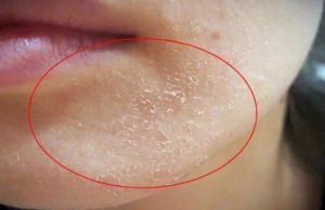 Красные пятна на лице, шелушатся и чешутся