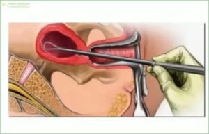 Гистероскопия при ОРЗ