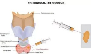 Биопсия языка