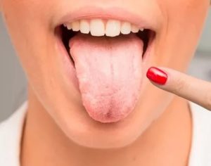 Жжение языка, трещины, отпечатки зубов на языке