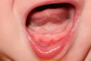 Осиплость голоса и прорезывание зубов