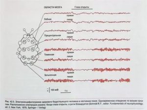 Помогите расшифровать результаты ЭЭГ