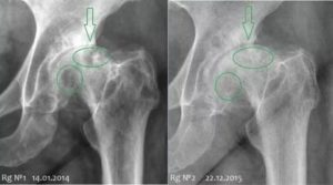 Кистовидные просветления в головках бедренных костей