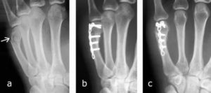 Перелом основания 2 пястной кости со смещением
