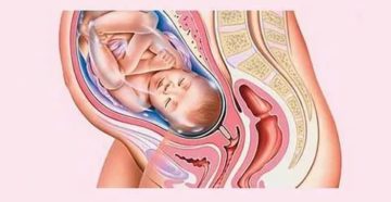 Беременность, тонус матки, отмена утрожестана