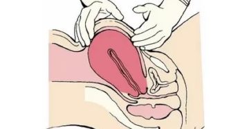 Секс при тонусе матки