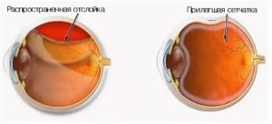 Сетчатка не прилегает плотно после пломбирования