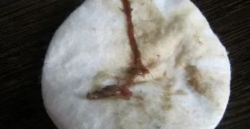 Беременность 17 неделя. Коричневые выделения и зуд Беременность 17 неделя. Коричневые выделения и зуд