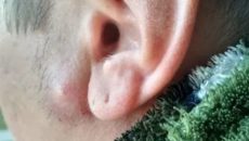 Шишка на лице возле уха
