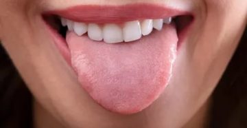 Жжение языка, трещины, отпечатки зубов на языке