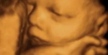 Маловодие на 33 недели Маловодие на 33 недели