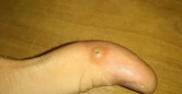 На руке появилась ранка похожая на мозоль