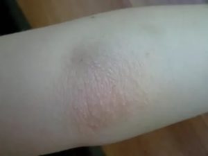Аллергия на локтях и коленях