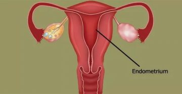 Скудные месячные и тонкий эндометрий Скудные месячные и тонкий эндометрий