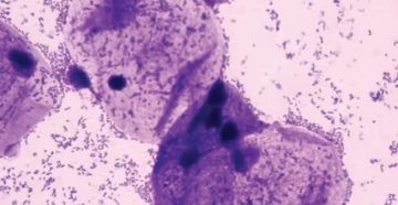 В мазке коккобациллярная флора В мазке коккобациллярная флора