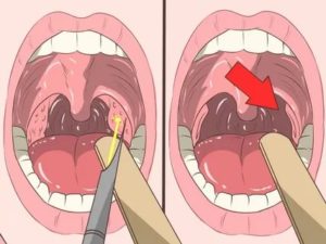 В горле странная шишка, не мешает, хронический тонзиллит