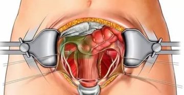 Боли после удаления придатков Боли после удаления придатков