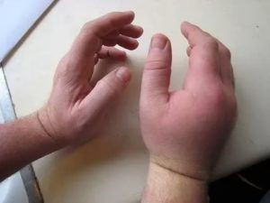 У ребенка отекли кисти рук