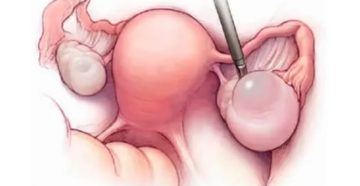 Уплотнения в области яичников