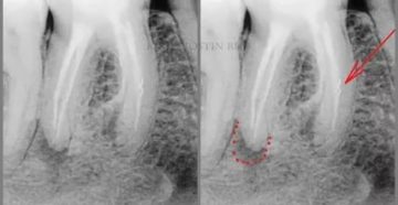 Сломан инструмент в корне зуба
