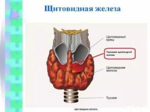 Образование в перешейке щитовидной железы