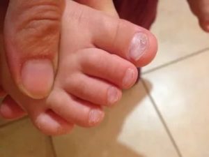 Слоятся ногти у ребенка